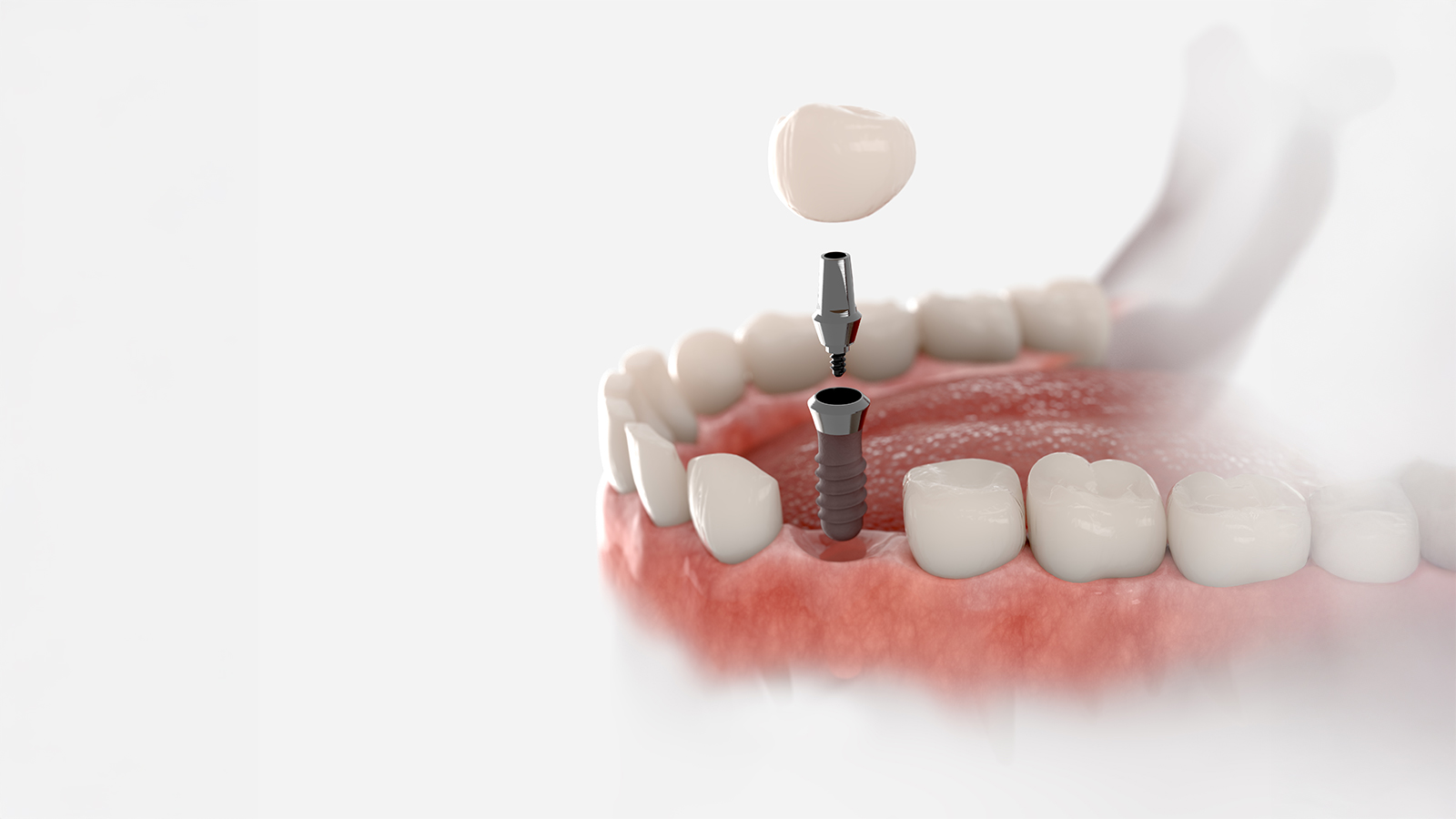 3D rendering of a dental implant showing the titanium post in the jawbone, abutment connector, and crown being placed